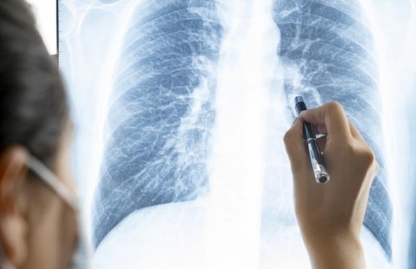 Длительный COVID связан с длительным заболеванием дыхательных путей