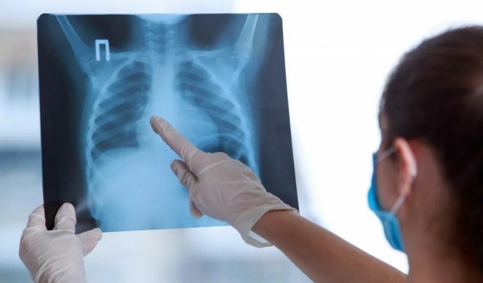 Ценность рентгеновского снимка при диагнозе COVID-19